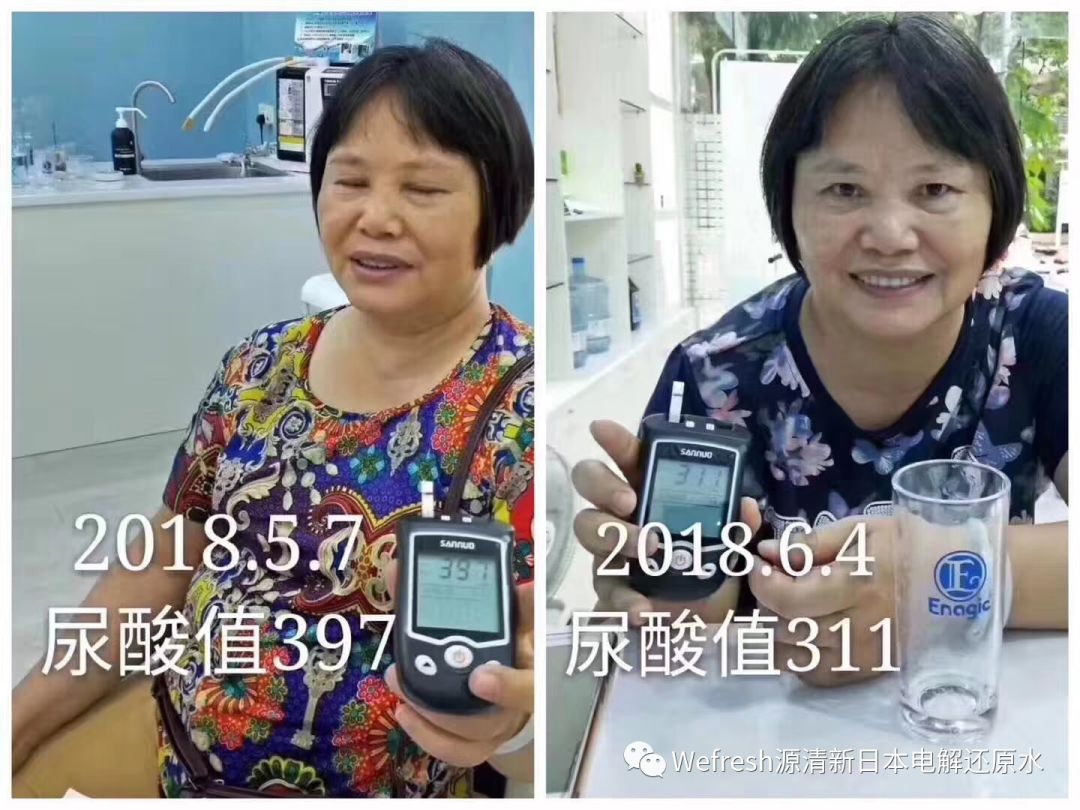 还原水让“尿酸高”，痛风不治而愈