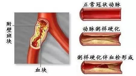 水管堵了可以通,血管堵了怎么办?!-还原水